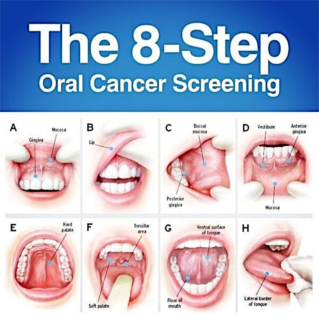 8 step oral cancer screening 1024x1024 - La prevención del cáncer oral evitaria 4.000 casos al año en España