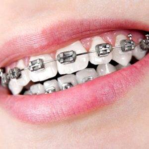 brackets dentales