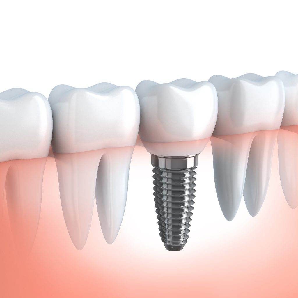 Implantes dentales Torrelodones