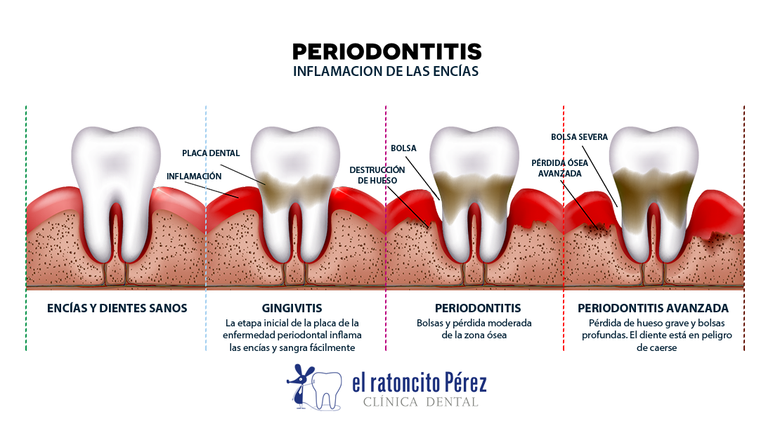 periodontitis - Periodoncia